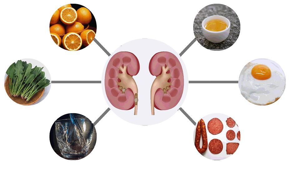 草酸钙结石饮食 肾结石该吃什么?